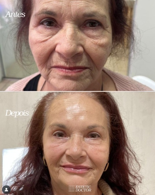 Resultado Toxina com Peptídeos